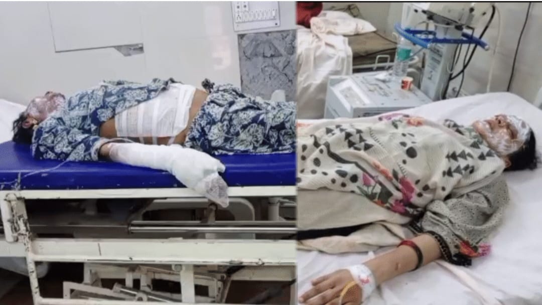 मां-बेटी संदिग्ध परिस्थितियों में झुलसीं, हालत गंभीर